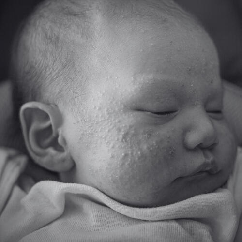 Skin Rashes (i.e., Eczema, "Chicken Skin")